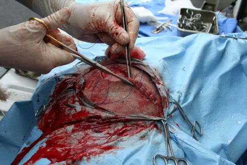 Cesarean Stitches