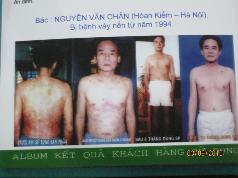 các giai đoạn của bệnh nhân bị Vảy Nến
